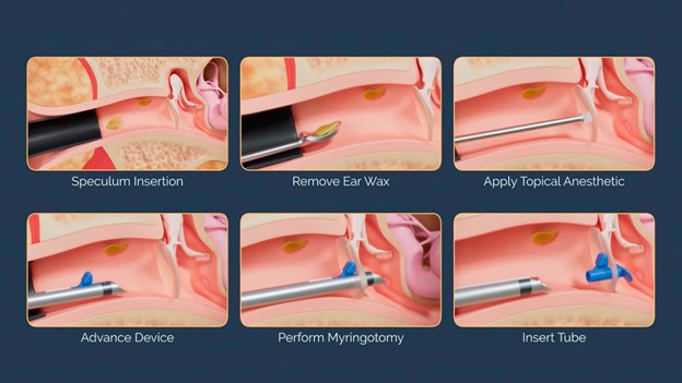 HummingBird Procedure at Pikes Peak ENT, Allergy and Asthma